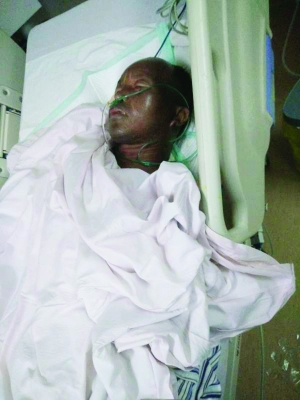 氢气球爆炸致重度烧伤